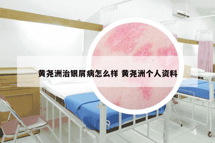 黄尧洲治银屑病怎么样 黄尧洲个人资料