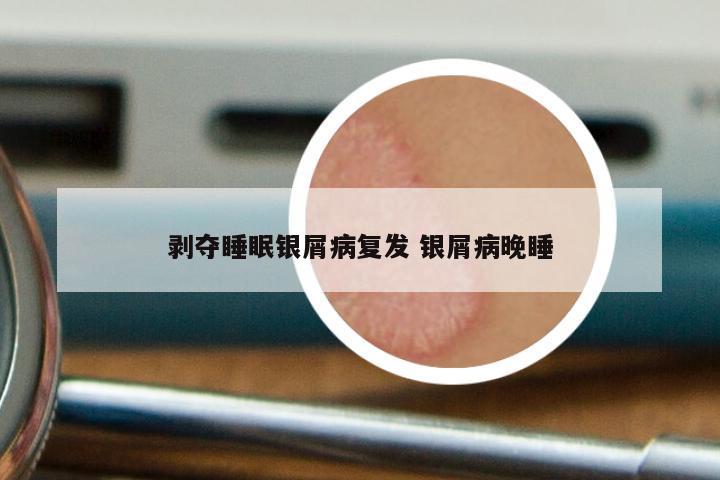 剥夺睡眠银屑病复发 银屑病晚睡