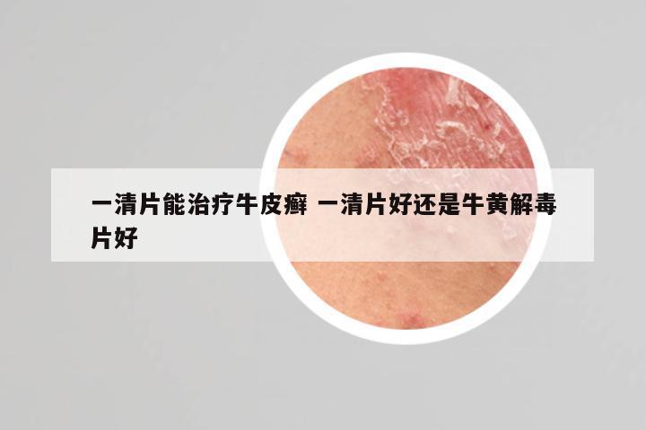 一清片能治疗牛皮癣 一清片好还是牛黄解毒片好