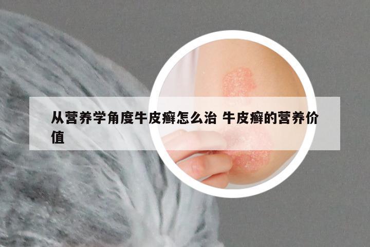 从营养学角度牛皮癣怎么治 牛皮癣的营养价值