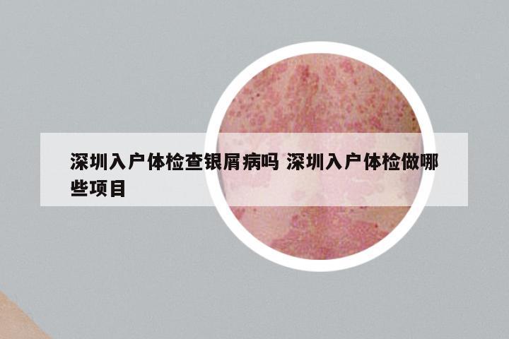 深圳入户体检查银屑病吗 深圳入户体检做哪些项目