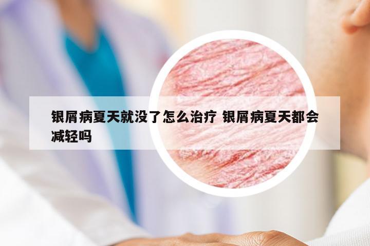 银屑病夏天就没了怎么治疗 银屑病夏天都会减轻吗