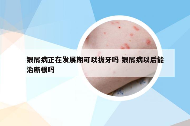 银屑病正在发展期可以拔牙吗 银屑病以后能治断根吗