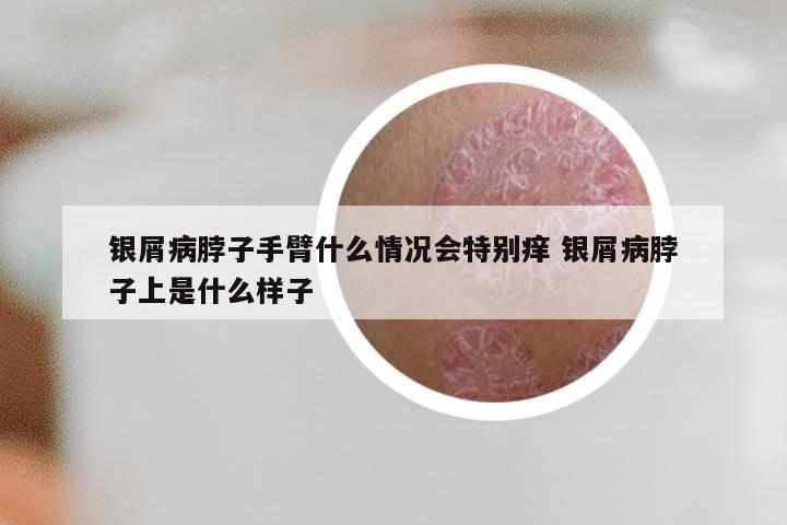 银屑病脖子手臂什么情况会特别痒 银屑病脖子上是什么样子