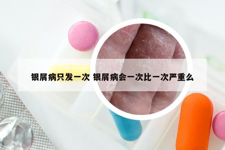 银屑病只发一次 银屑病会一次比一次严重么