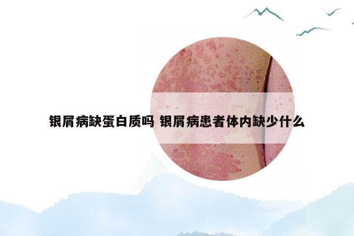 银屑病缺蛋白质吗 银屑病患者体内缺少什么