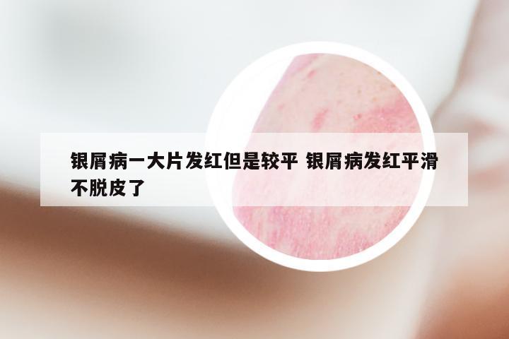 银屑病一大片发红但是较平 银屑病发红平滑不脱皮了