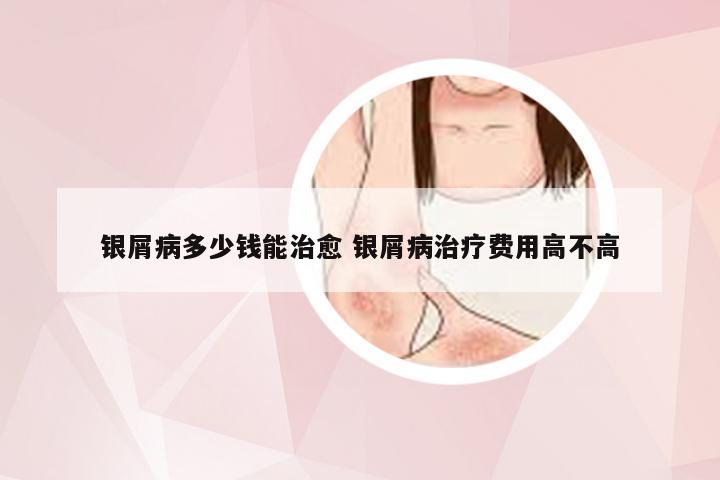 银屑病多少钱能治愈 银屑病治疗费用高不高