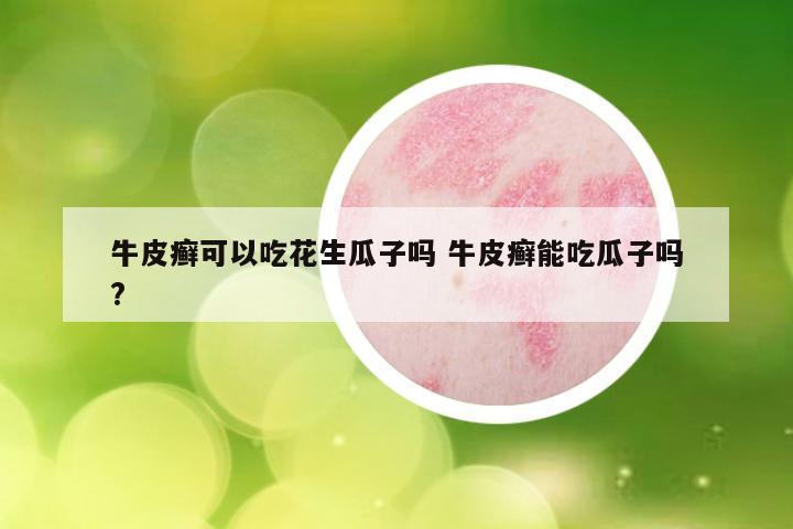 牛皮癣可以吃花生瓜子吗 牛皮癣能吃瓜子吗?