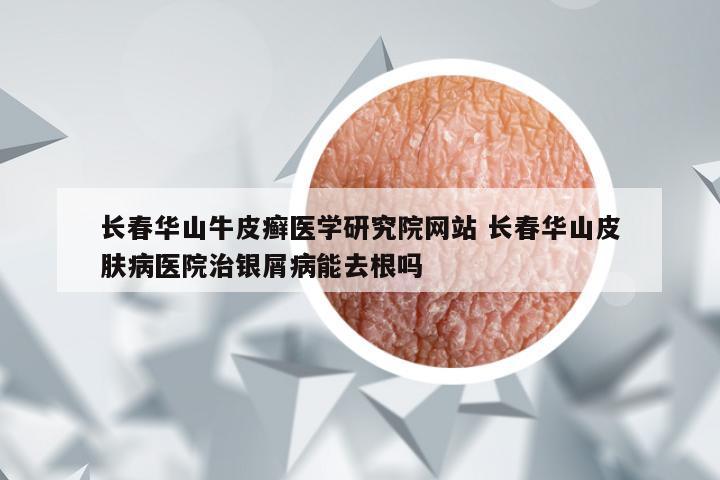 长春华山牛皮癣医学研究院网站 长春华山皮肤病医院治银屑病能去根吗