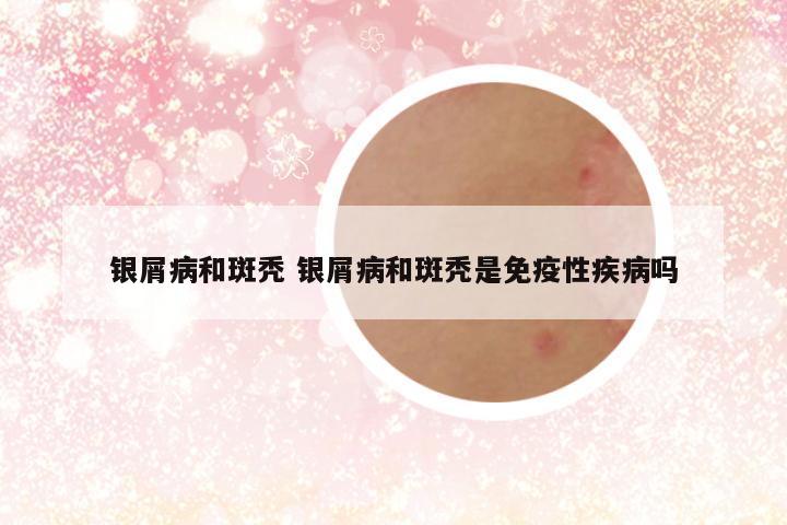 银屑病和斑秃 银屑病和斑秃是免疫性疾病吗