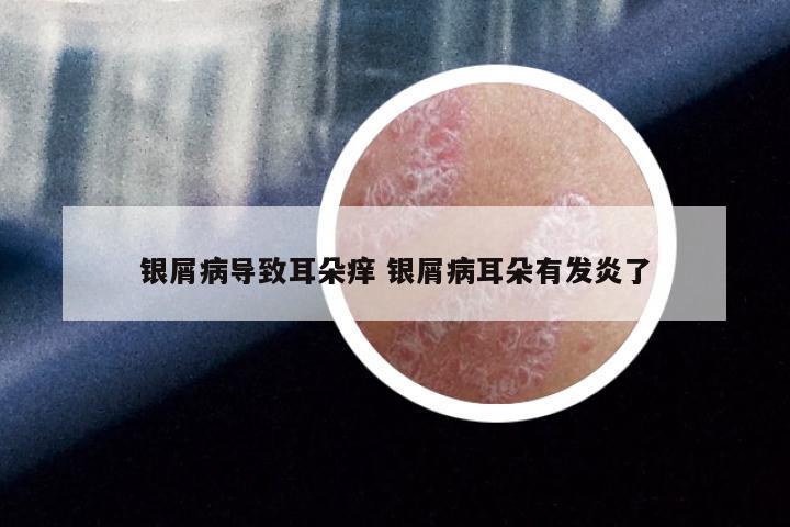 银屑病导致耳朵痒 银屑病耳朵有发炎了