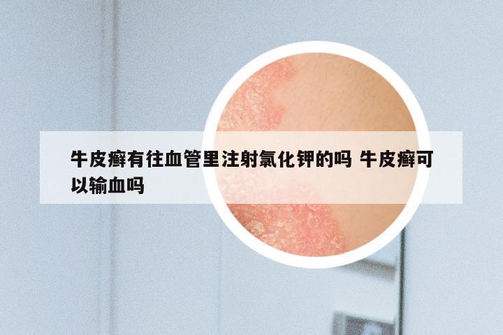 牛皮癣有往血管里注射氯化钾的吗 牛皮癣可以输血吗