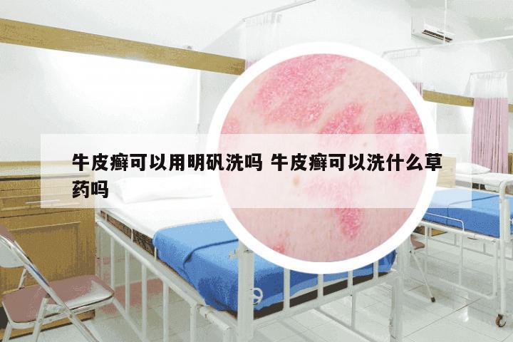 牛皮癣可以用明矾洗吗 牛皮癣可以洗什么草药吗
