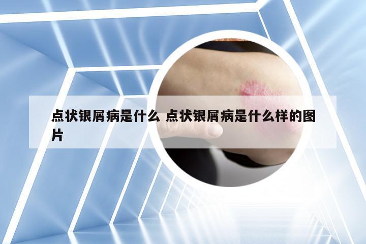 点状银屑病是什么 点状银屑病是什么样的图片