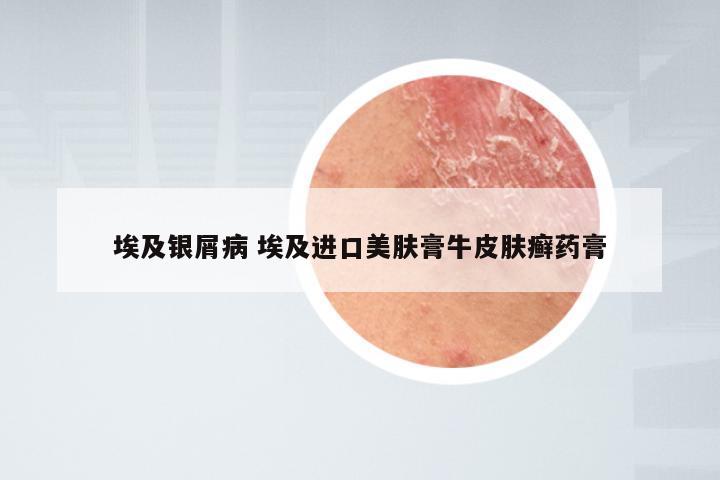 埃及银屑病 埃及进口美肤膏牛皮肤癣药膏