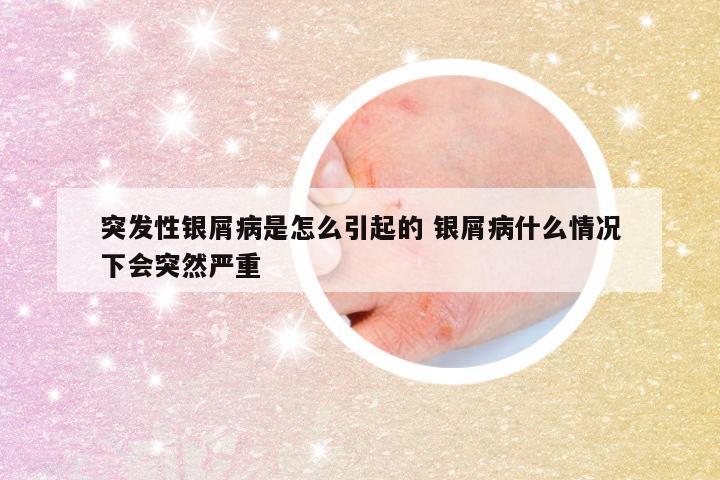 突发性银屑病是怎么引起的 银屑病什么情况下会突然严重