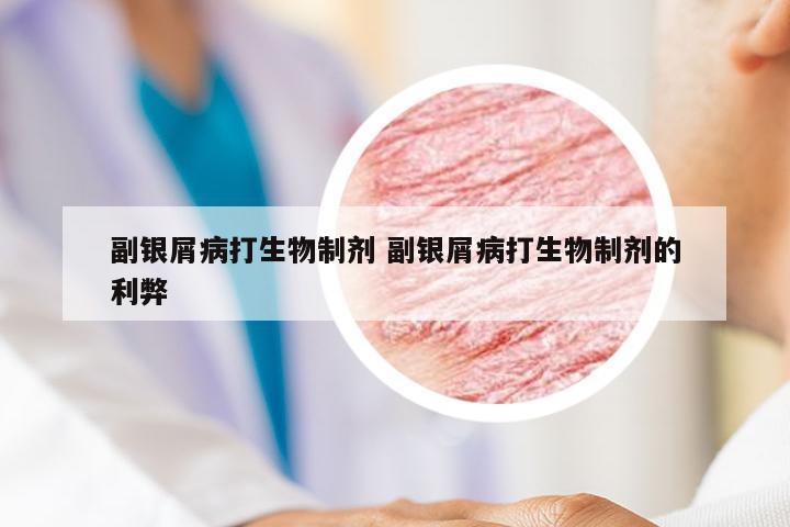 副银屑病打生物制剂 副银屑病打生物制剂的利弊