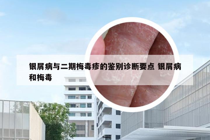 银屑病与二期梅毒疹的鉴别诊断要点 银屑病和梅毒