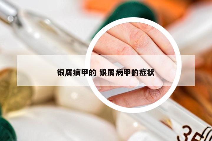 银屑病甲的 银屑病甲的症状