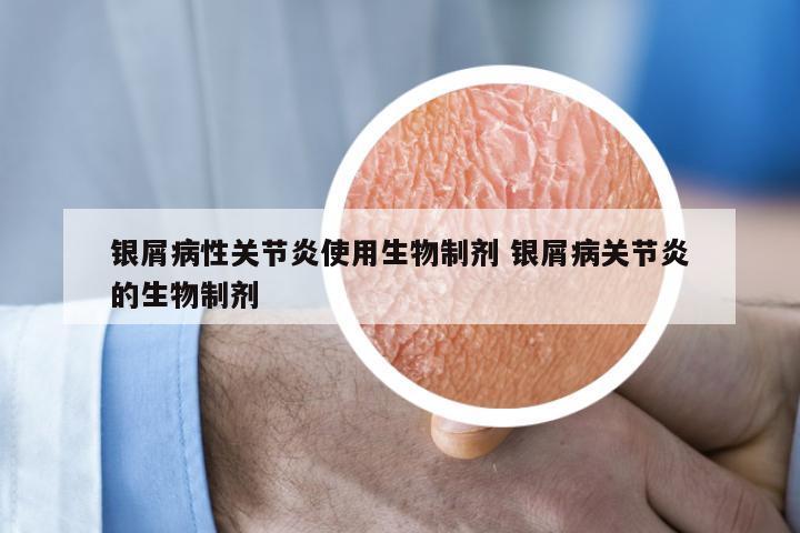 银屑病性关节炎使用生物制剂 银屑病关节炎的生物制剂