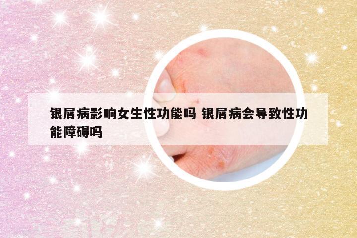 银屑病影响女生性功能吗 银屑病会导致性功能障碍吗