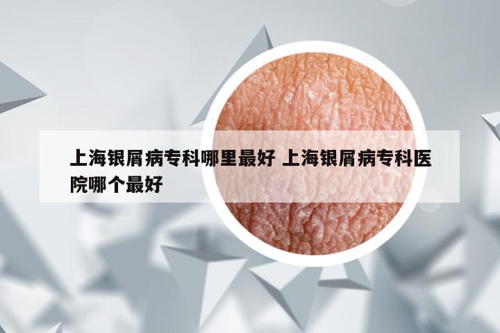 上海银屑病专科哪里最好 上海银屑病专科医院哪个最好