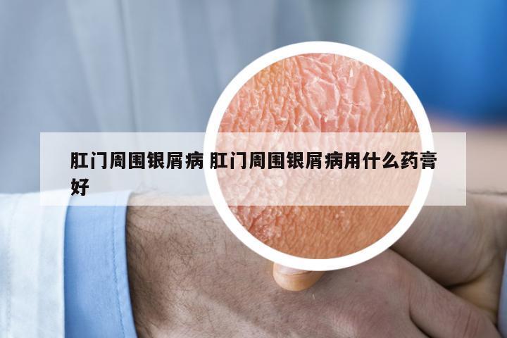 肛门周围银屑病 肛门周围银屑病用什么药膏好
