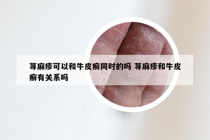 荨麻疹可以和牛皮癣同时的吗 荨麻疹和牛皮癣有关系吗