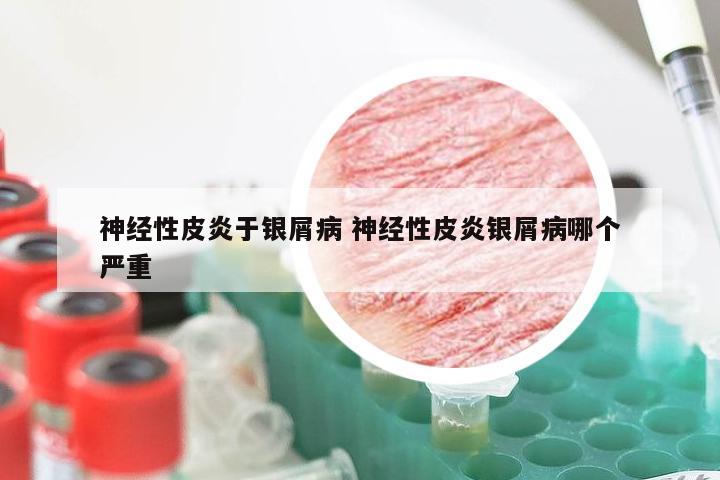 神经性皮炎于银屑病 神经性皮炎银屑病哪个严重