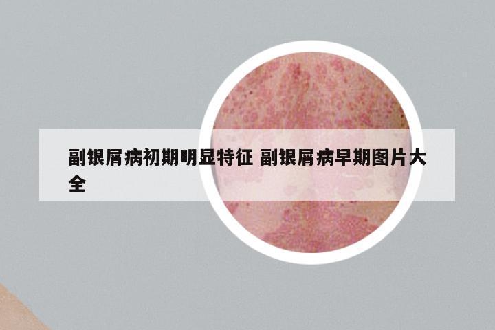 副银屑病初期明显特征 副银屑病早期图片大全