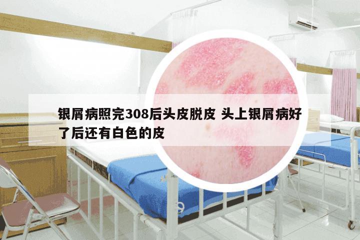 银屑病照完308后头皮脱皮 头上银屑病好了后还有白色的皮