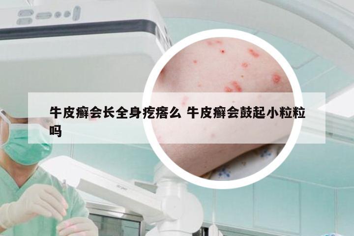 牛皮癣会长全身疙瘩么 牛皮癣会鼓起小粒粒吗