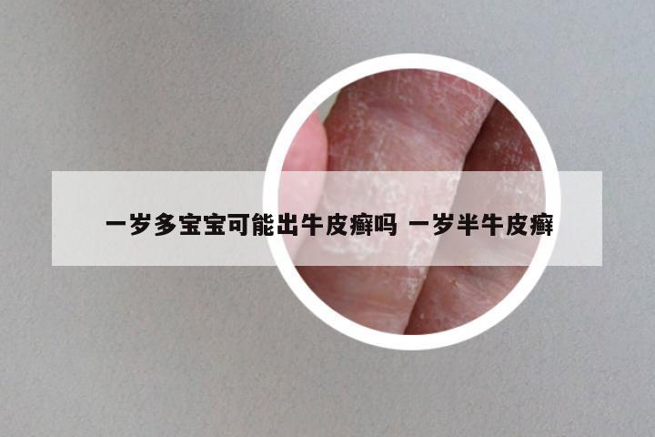 一岁多宝宝可能出牛皮癣吗 一岁半牛皮癣