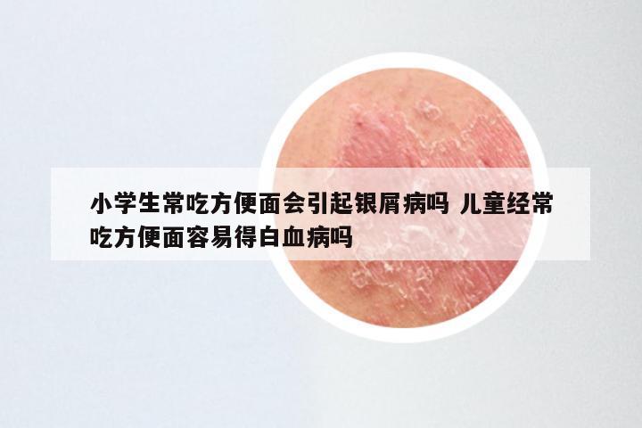 小学生常吃方便面会引起银屑病吗 儿童经常吃方便面容易得白血病吗