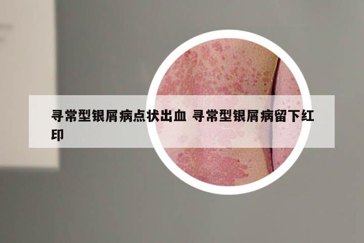 寻常型银屑病点状出血 寻常型银屑病留下红印