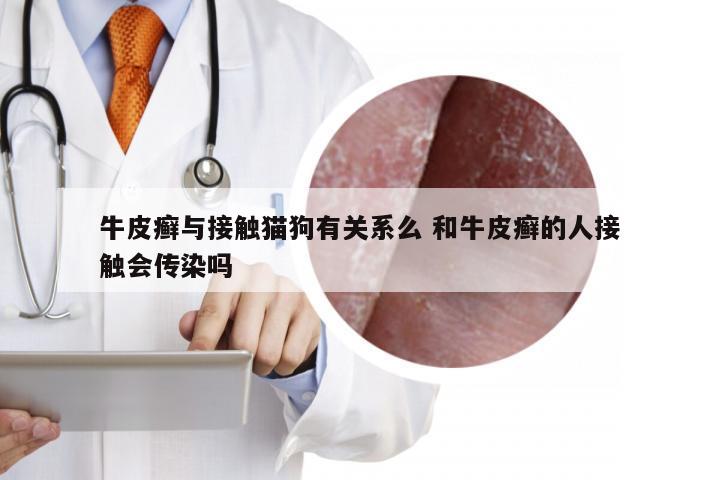 牛皮癣与接触猫狗有关系么 和牛皮癣的人接触会传染吗