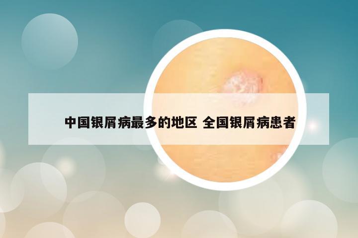 中国银屑病最多的地区 全国银屑病患者