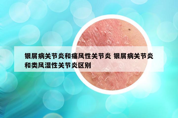 银屑病关节炎和痛风性关节炎 银屑病关节炎和类风湿性关节炎区别