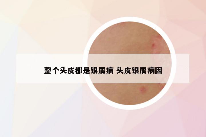 整个头皮都是银屑病 头皮银屑病因