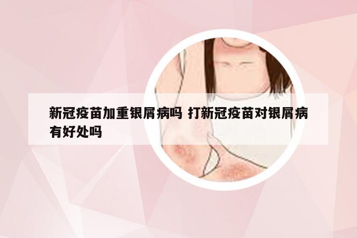 新冠疫苗加重银屑病吗 打新冠疫苗对银屑病有好处吗