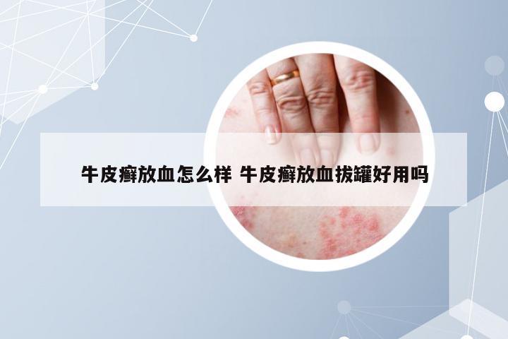 牛皮癣放血怎么样 牛皮癣放血拔罐好用吗