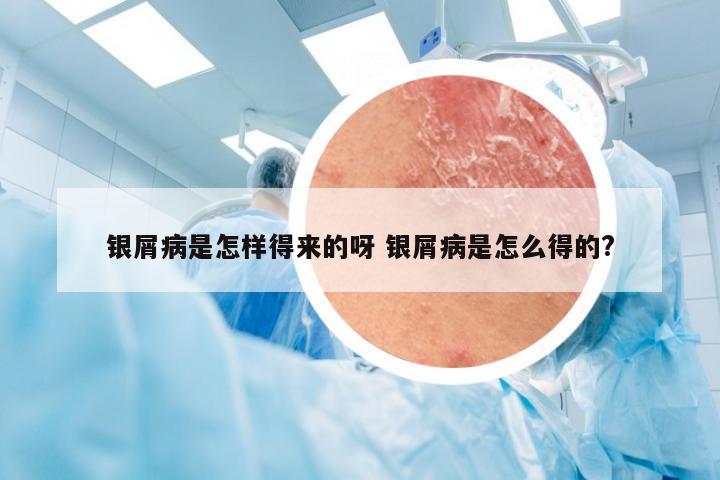银屑病是怎样得来的呀 银屑病是怎么得的?
