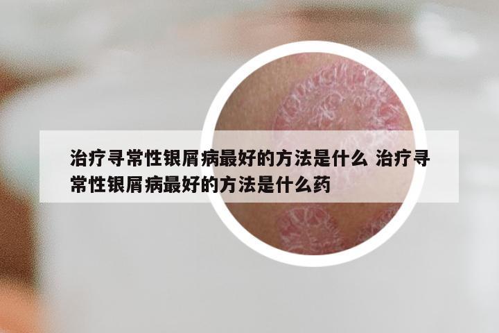 治疗寻常性银屑病最好的方法是什么 治疗寻常性银屑病最好的方法是什么药