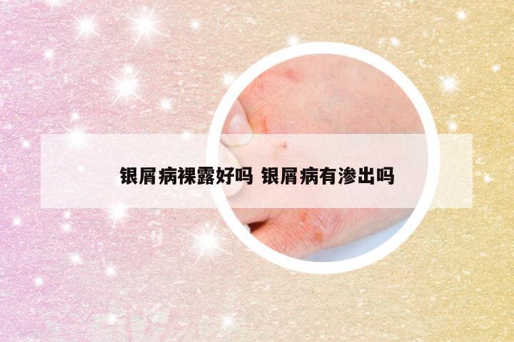 银屑病裸露好吗 银屑病有渗出吗