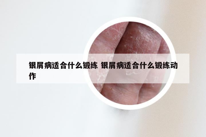 银屑病适合什么锻练 银屑病适合什么锻练动作