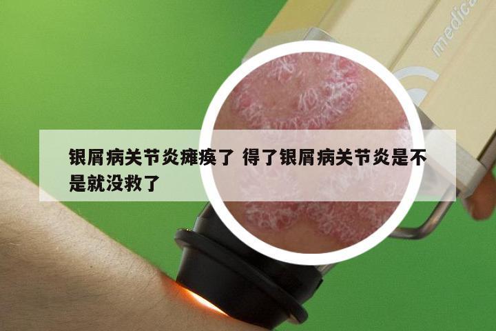 银屑病关节炎瘫痪了 得了银屑病关节炎是不是就没救了