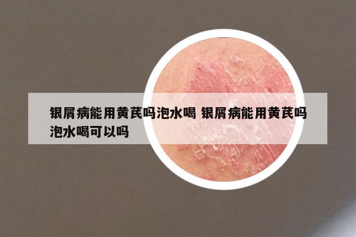 银屑病能用黄芪吗泡水喝 银屑病能用黄芪吗泡水喝可以吗