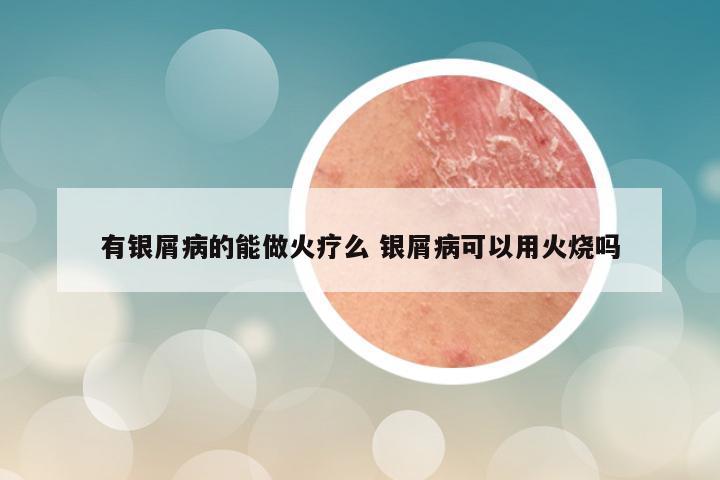 有银屑病的能做火疗么 银屑病可以用火烧吗