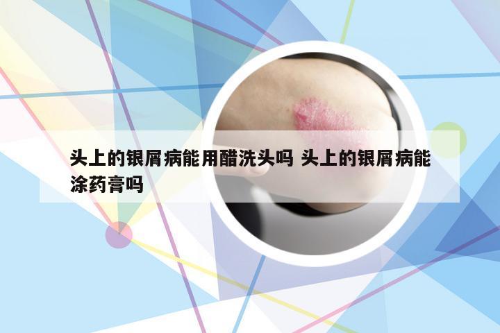 头上的银屑病能用醋洗头吗 头上的银屑病能涂药膏吗